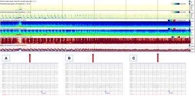 BIRDs (Brief Potentially Ictal Rhythmic Discharges) watching during EEG monitoring